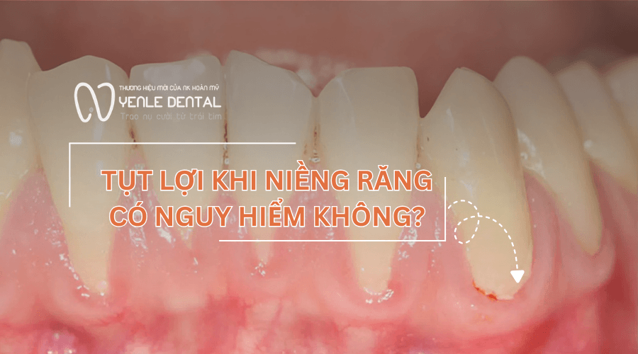 tụt lợi khi niềng răng